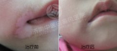 儿童早期如何能治好
