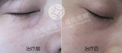 女性白癜风这样的护理