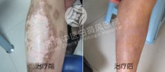为什么会出现女性白癜风复发情况