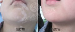 儿童白癜风不能吃的那些食物