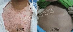 完全型白癜风怎样的护理
